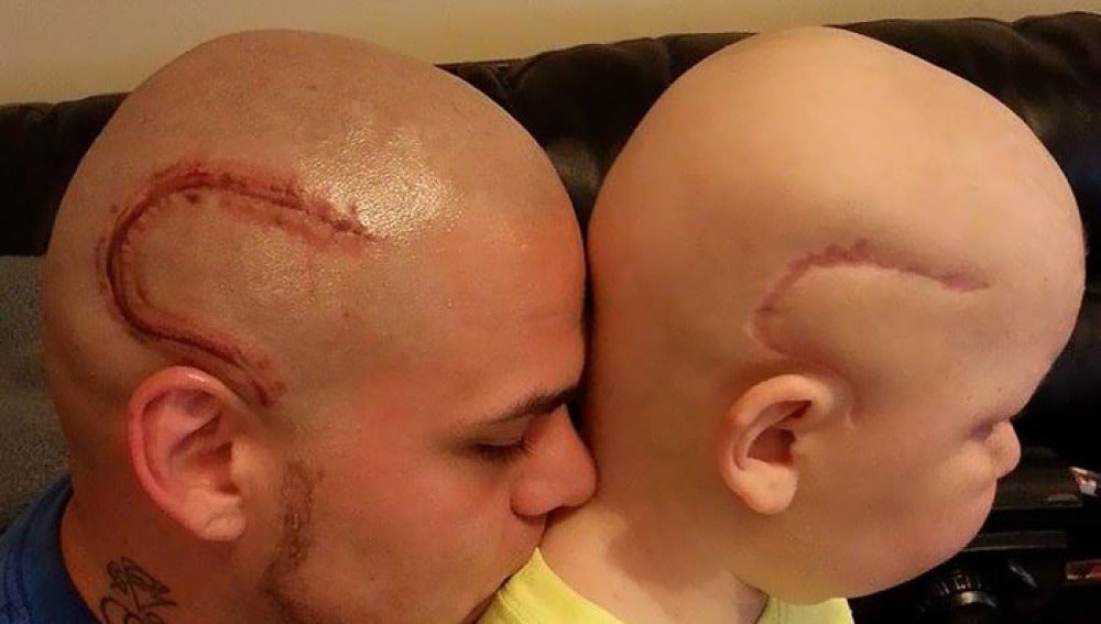 Un padre se tatúa la cicatriz de su hijo para que se sienta normal