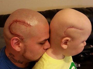 Un padre se tatúa la cicatriz de su hijo para que se sienta normal
