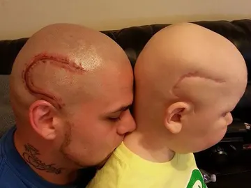 Un padre se tatúa la cicatriz de su hijo para que se sienta normal Un padre se tatúa la cicatriz de su hijo para que se sienta normal