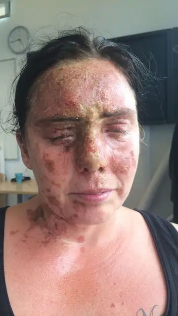 Imagen de la víctima tras ser rociada con ácido. Imagen de la víctima tras ser rociada con ácido.