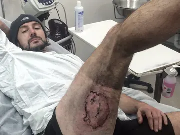 La quemadura producida por la explosión de un iPhone en el muslo de Gareth Clear La quemadura producida por la explosión de un iPhone en el muslo de Gareth Clear