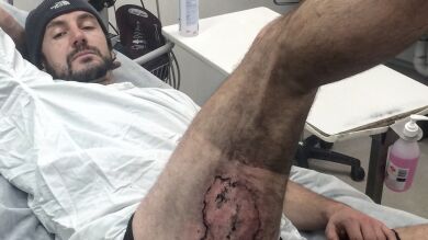 Un australiano sufre graves quemaduras en el muslo tras la explosión de su nuevo iPhone