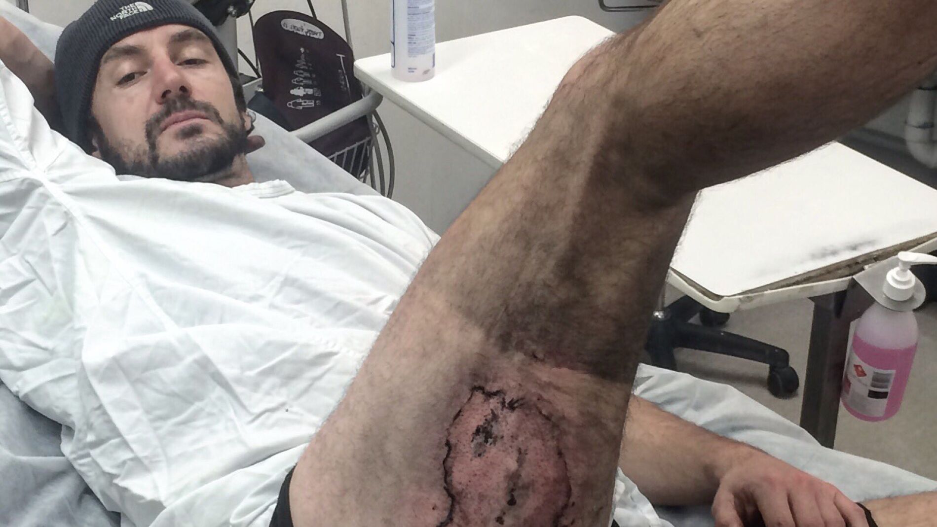 La quemadura producida por la explosi&oacute;n de un iPhone en el muslo de Gareth Clear