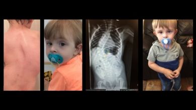 Intentan salvar la vida de un niño británico cuya columna tiene una curva de 57º