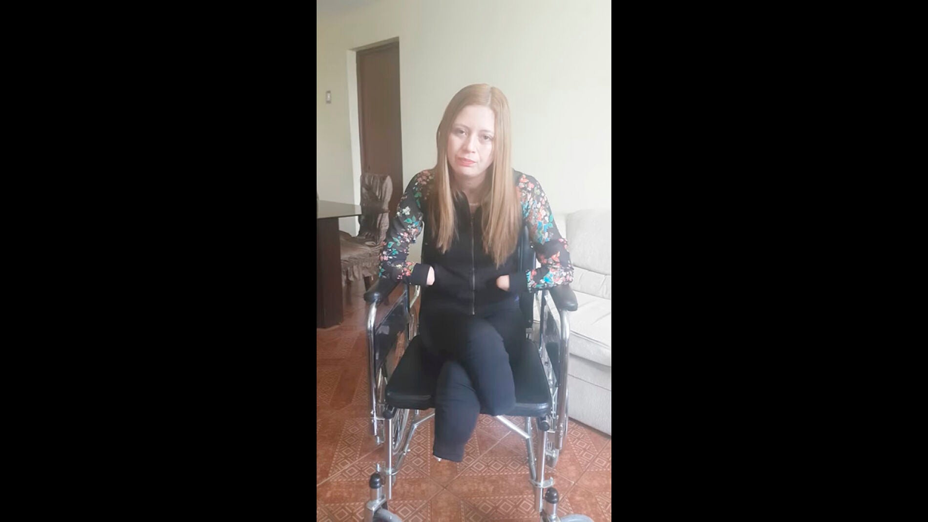 Joven peruana amputada pies y manos por negligencia m&eacute;dica 