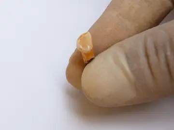 Diente de un niño neandertal que vivió en la Cova de les Teixoneres Diente de un niño neandertal que vivió en la Cova de les Teixoneres