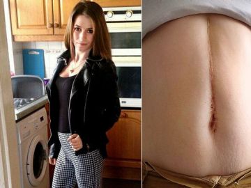 Jasmin Percival y su cicatriz tras la operación