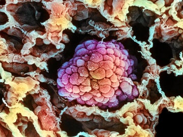 Imagen microscópica de un tumor durante su proceso de expansión 