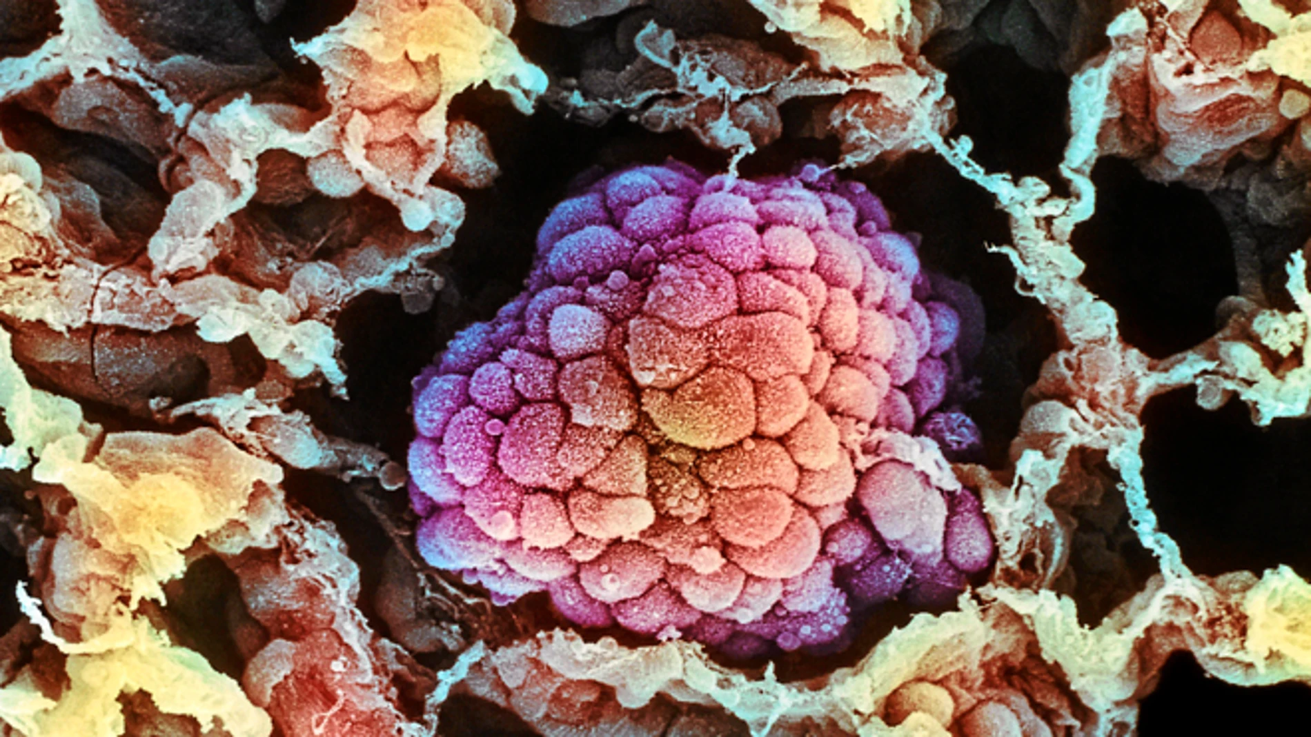 Imagen microscópica de un tumor durante su proceso de expansión Imagen microscópica de un tumor durante su proceso de expansión