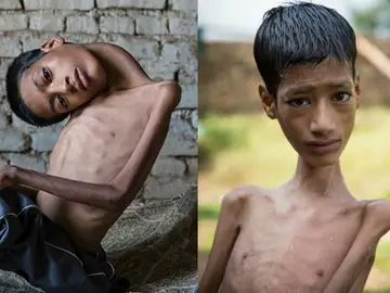 Mahendra Ahirwar antes y después de la operación de cuello Mahendra Ahirwar antes y después de la operación de cuello