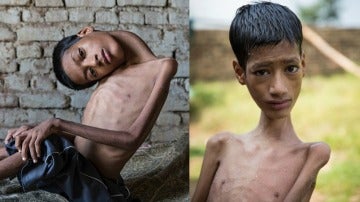 Mahendra Ahirwar antes y después de la operación de cuello
