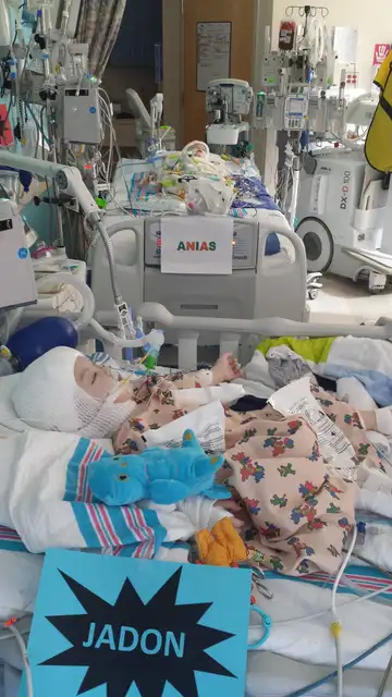 Jadon, uno de los siameses ya operado Jadon, uno de los siameses ya operado
