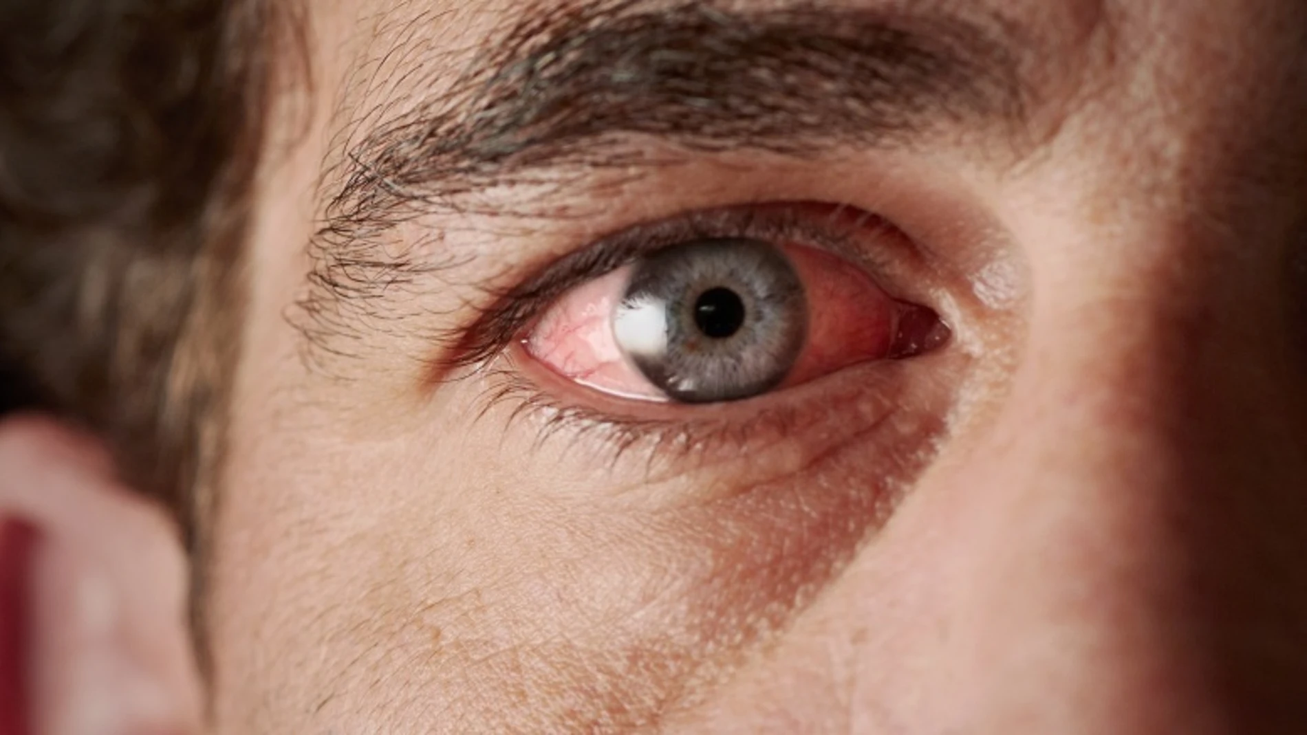 Daño en los ojos Daño en los ojos