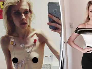 Jodie-Leigh Neila ante y después de ser ingresada Jodie-Leigh Neila ante y después de ser ingresada