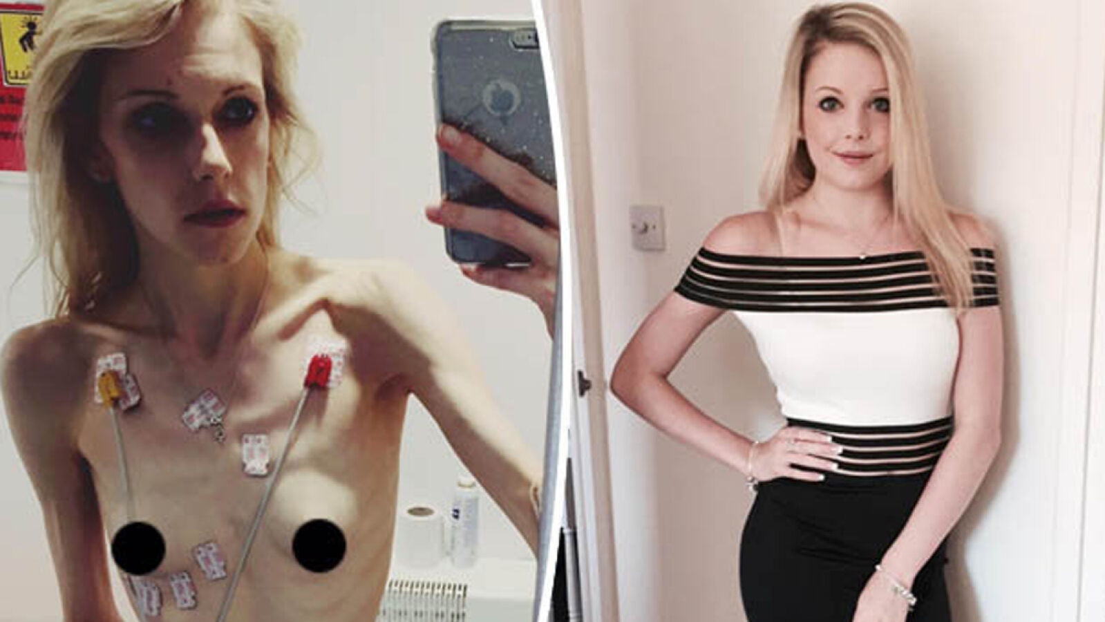 El éxito de una joven luchadora contra la anorexia que ha pasado de los 35 a los 63 kilos: 
