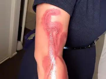 Las quemaduras que ha sufrido en el brazo Las quemaduras que ha sufrido en el brazo