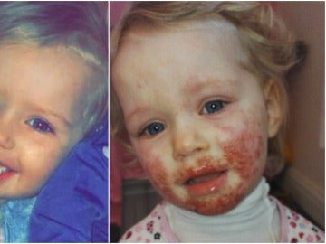 La niña que se ha recuperado después de un año con un herpes en la cara