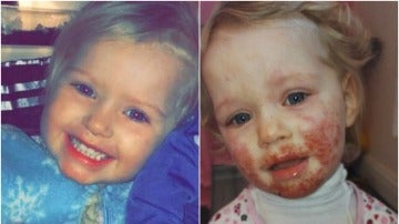 La niña que se ha recuperado después de un año con un herpes en la cara