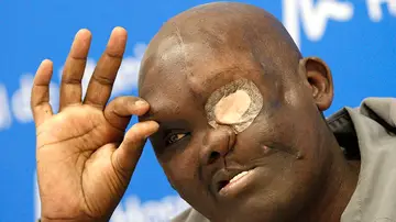 Mike Koech tras ser operado de un tumor gigante Mike Koech tras ser operado de un tumor gigante