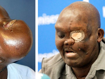 El paciente Mike Koech en dos imágenes, antes y despues, de ser operado por el doctor Pedro Cavadas 