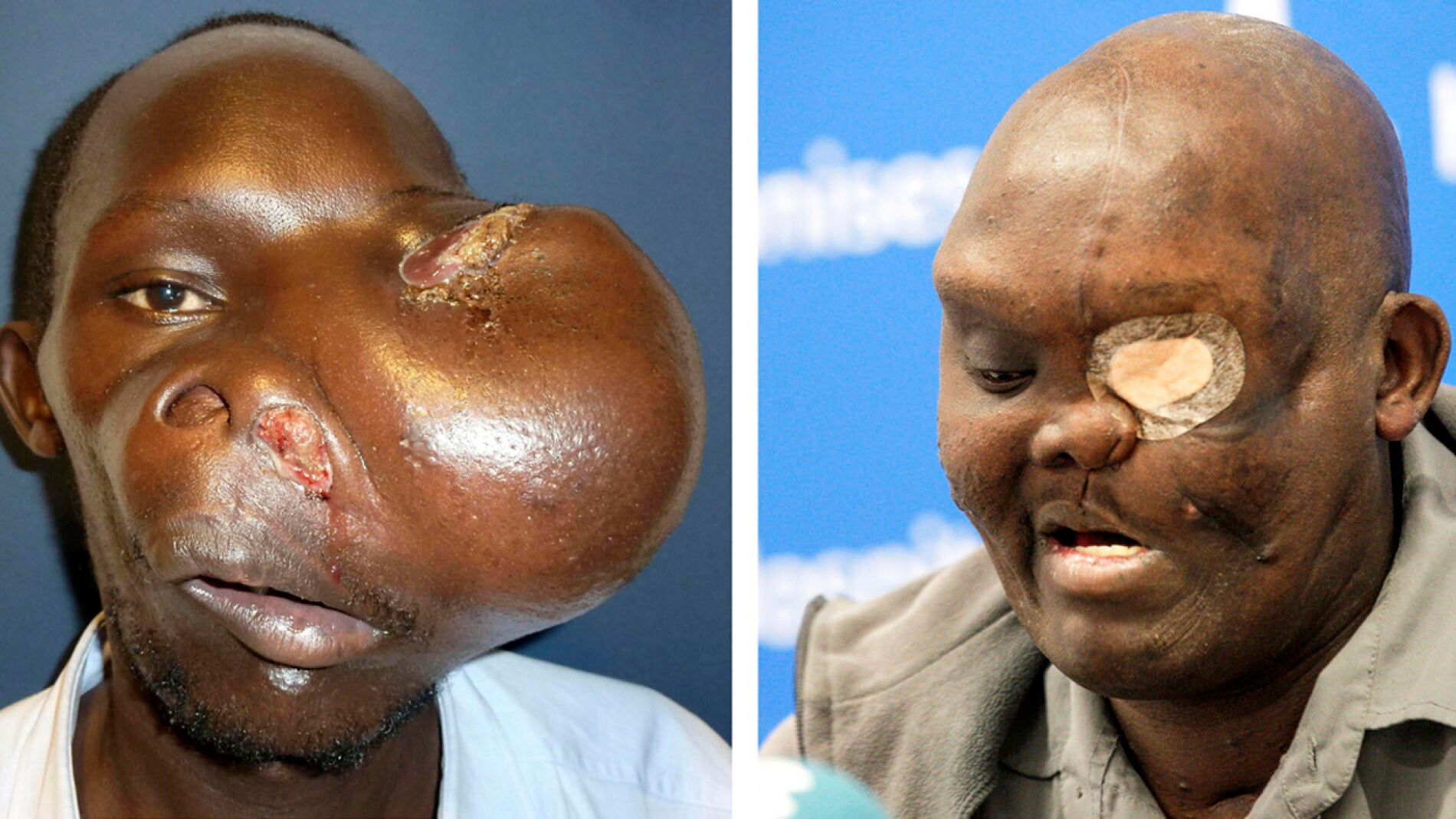 El paciente Mike Koech en dos im&aacute;genes, antes y despues, de ser operado por el doctor Pedro Cavadas 