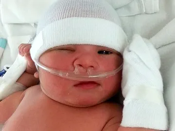 Bebé con enfermedad rara Bebé con enfermedad rara