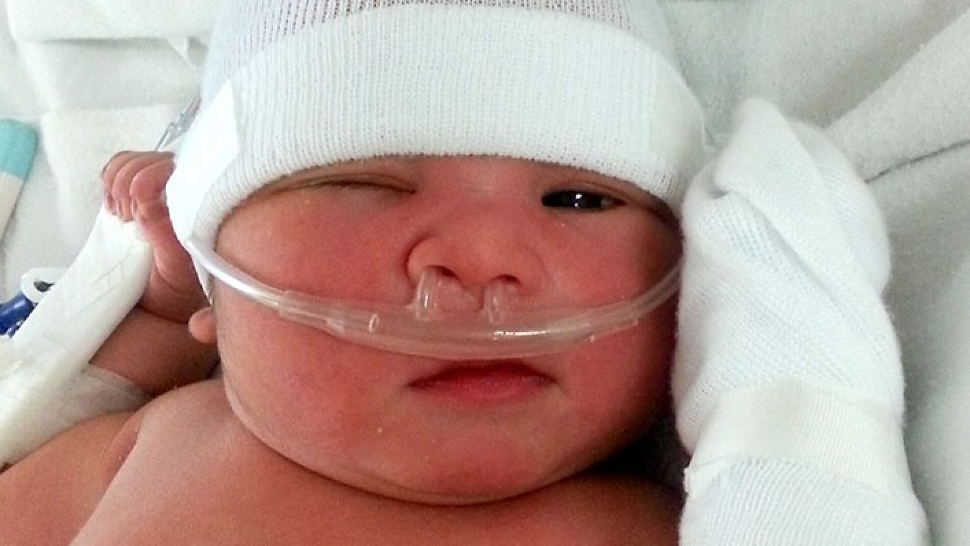 Beb&eacute; con enfermedad rara