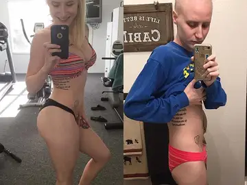 El cuerpo de Cheyann Shaw antes y después de diagnosticarle la enfermedad El cuerpo de Cheyann Shaw antes y después de diagnosticarle la enfermedad