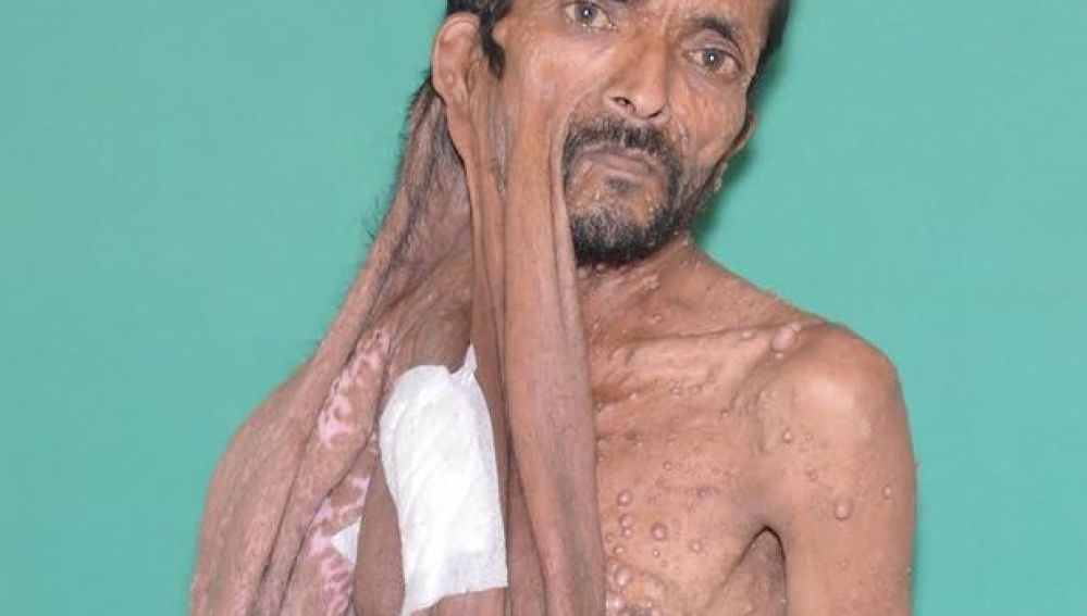 Extirpan un tumor facial de 11 kilos a un hombre en Nepal