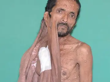 Tumor facial Tumor facial