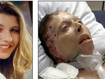Judy Malinowski, antes y después de haber sido quemada viva por su novio Judy Malinowski, antes y después de haber sido quemada viva por su novio