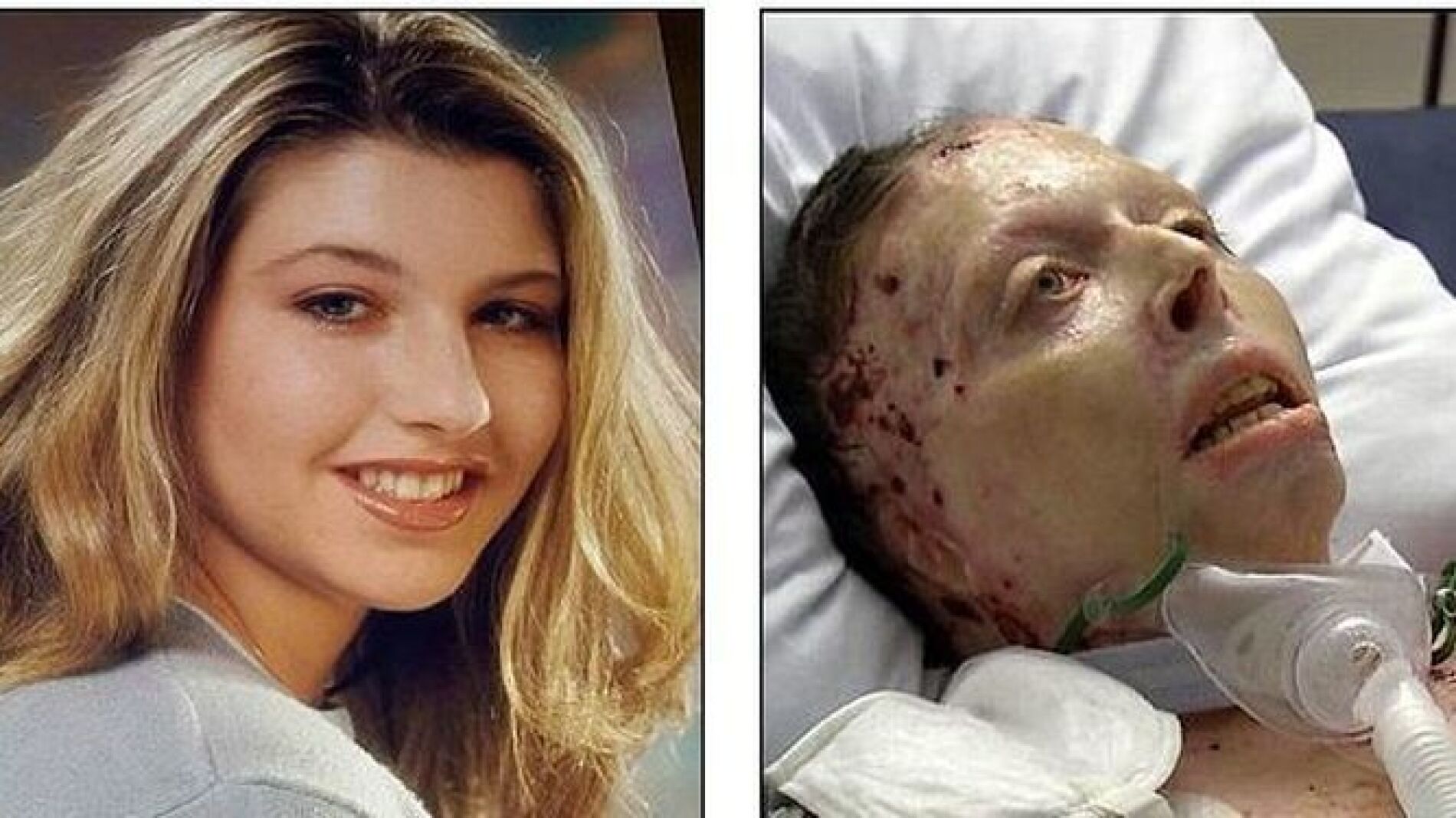 Judy Malinowski, antes y despu&eacute;s de haber sido quemada viva por su novio