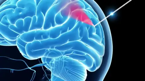 Frame 5.742864 de: Desarrollan una "aguja inteligente" para operaciones de cerebro Frame 5.742864 de: Desarrollan una "aguja inteligente" para operaciones de cerebro