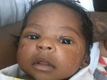 Kaheel sufre una enfermedad rara conocida como 'piel de mariposa' Kaheel sufre una enfermedad rara conocida como 'piel de mariposa'