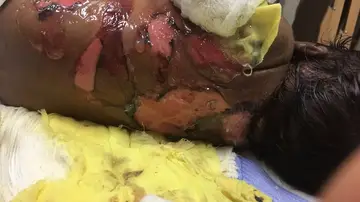 El pequeño Kaheel ha perdido ya el 60% de su piel El pequeño Kaheel ha perdido ya el 60% de su piel