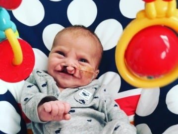 Brody, el bebé con labio leporino antes de ser operado