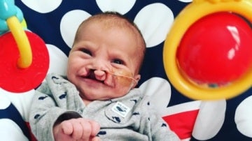 Brody, el bebé con labio leporino antes de ser operado