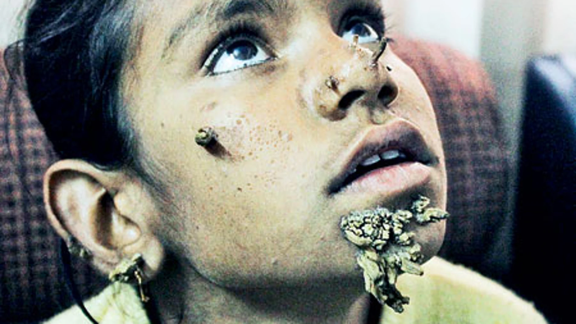 La niña diagnosticada con la enfermedad del 'hombre árbol' La niña diagnosticada con la enfermedad del 'hombre árbol'