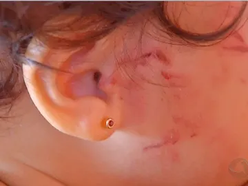 Agresión a una niña de dos años en una guardería de Brasil Agresión a una niña de dos años en una guardería de Brasil