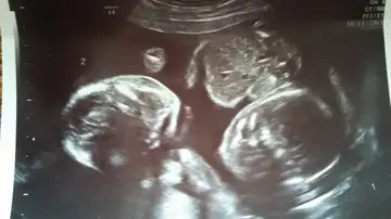 Una de las ecografías de Hayley Una de las ecografías de Hayley