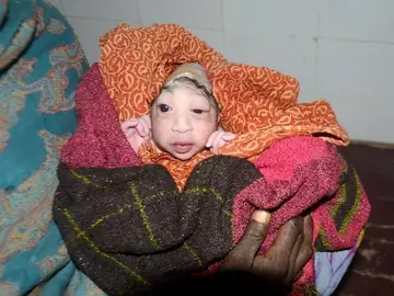 La pequeña con la malformación congénita La pequeña con la malformación congénita