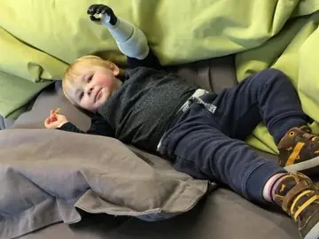 Sol con su nueva prótesis Sol con su nueva prótesis