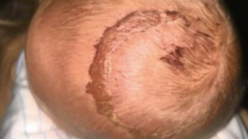 Heridas causadas en el bebé por el uso de la ventosa y el fórceps