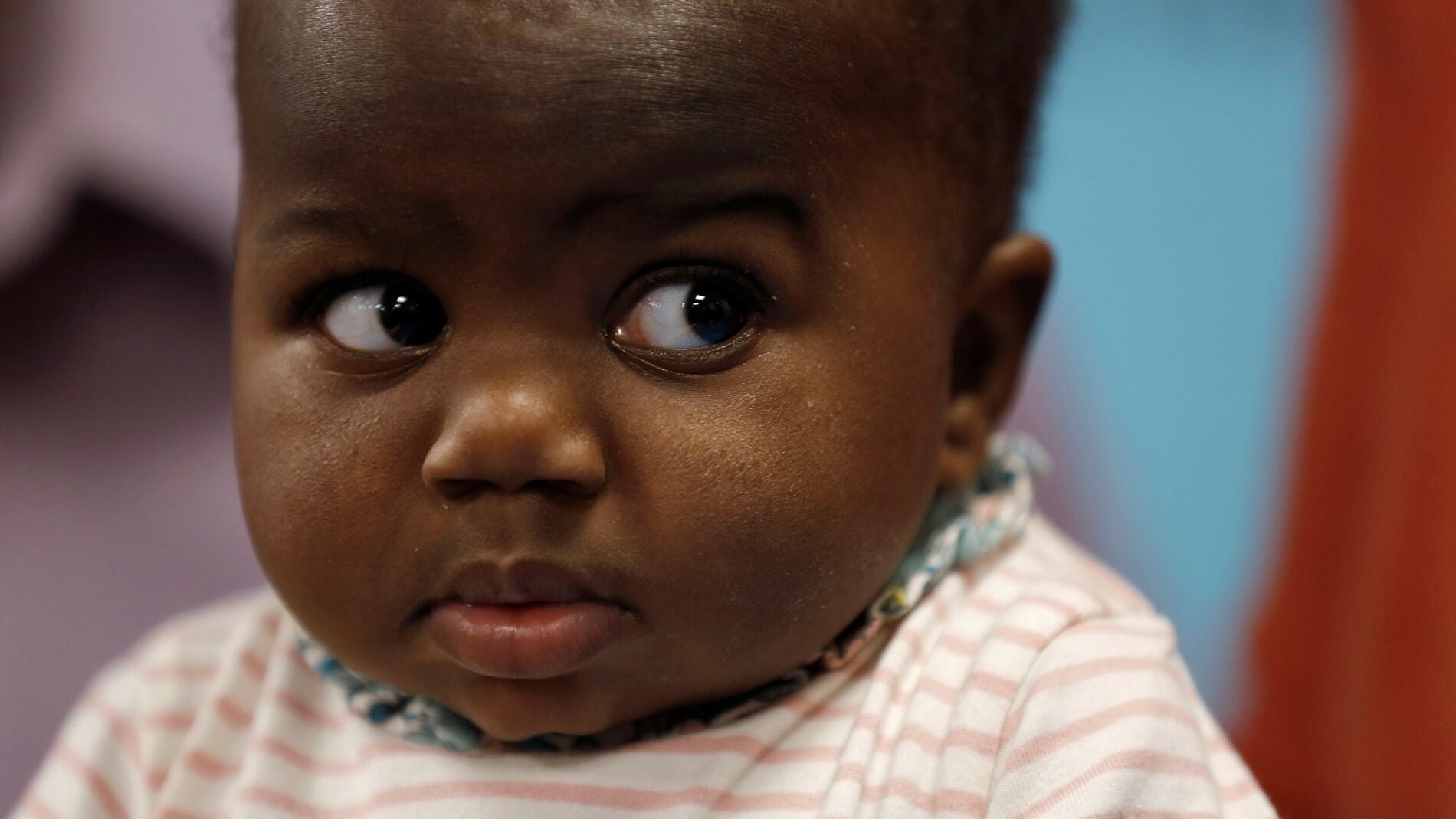Dominique, la ni&ntilde;a que naci&oacute; con cuatro piernas