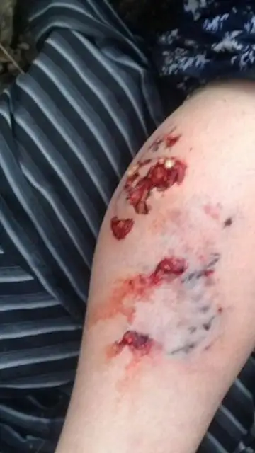 Las heridas causadas por la mordedura del perro Las heridas causadas por la mordedura del perro