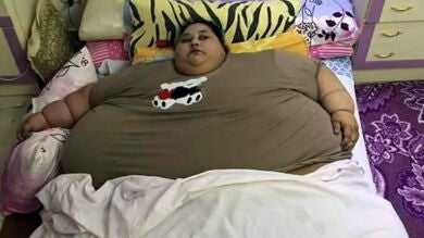 La hermana de la mujer egipcia operada en la India desmiente que perdiera 240 kilos