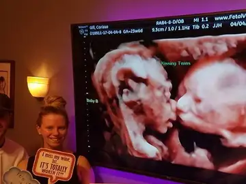 Una ecografía 4D dándose un beso Una ecografía 4D dándose un beso