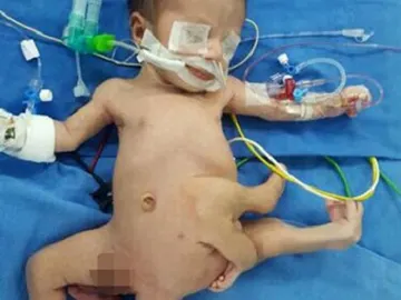 Un bebé nace con ocho extremidades y es operado con éxito en un hospital en la India Un bebé nace con ocho extremidades y es operado con éxito en un hospital en la India