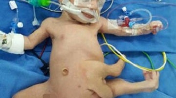 Un bebé nace con ocho extremidades y es operado con éxito en un hospital en la India
