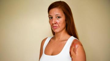 Joven atacada con ácido en una discoteca de Londres el pasado 22 de abril